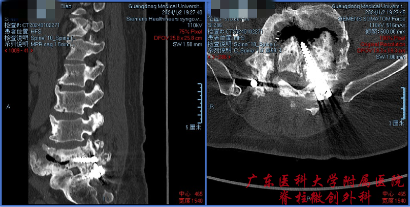 疑难病例不再难!借助3D打印技术开创新局面,脊柱微创外科成功解决DISH病复杂腰椎翻修手术!_腰椎间盘突出_腰椎间盘突出治疗方式 - 好大夫在线