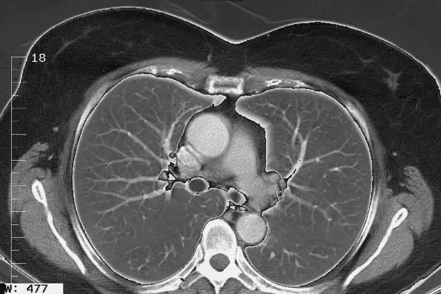 胸部ct断层解剖(二) - 好大夫在线