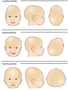宝宝出现位置性头颅畸形后,会有什么改变呢?会有危害吗?