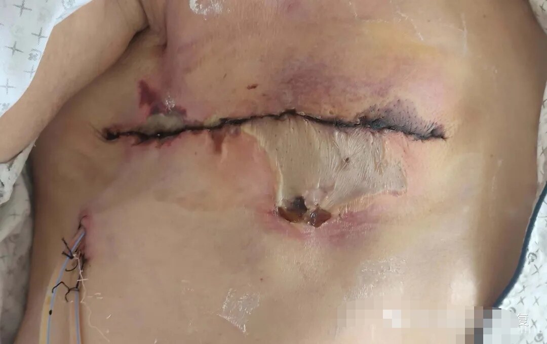 乳房切除后的样子伤口图片