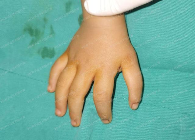 小女孩左手拇指发育不良,右手漂浮拇,复查发现恢复得很不错!