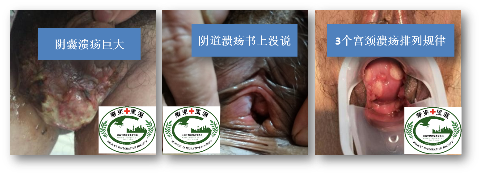 BS外阴溃疡3个特殊病例.png