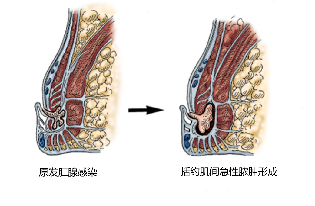 肛腺感染导致脓肿.jpg