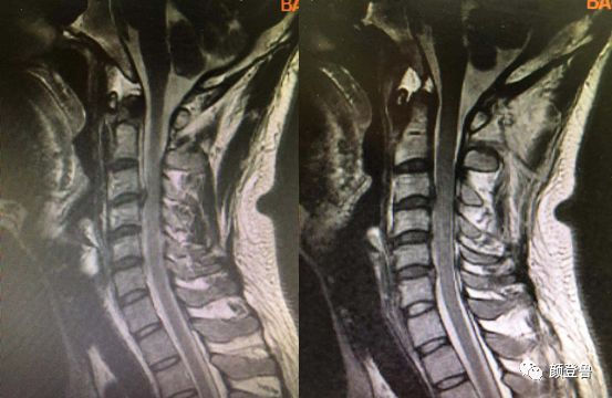 病是由于椎间盘退变和节段性不稳定等因素,从而对颈椎周围的交感神经