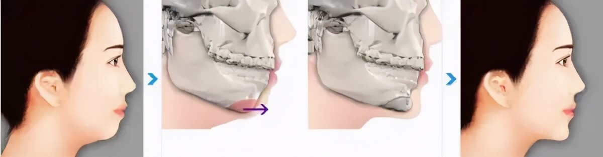 下颌整形_下颌整形治疗介绍 - 好大夫在线