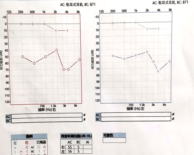 分泌性中耳炎听力检查中度聋png