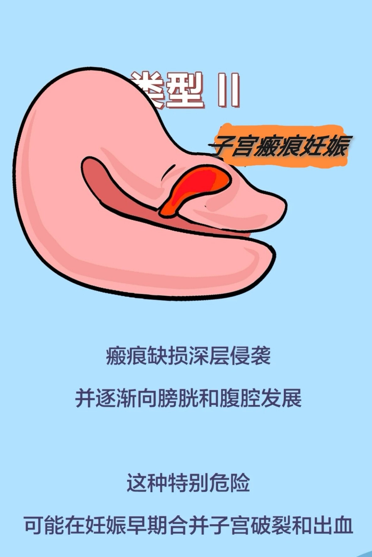 什么叫瘢痕子宫图片