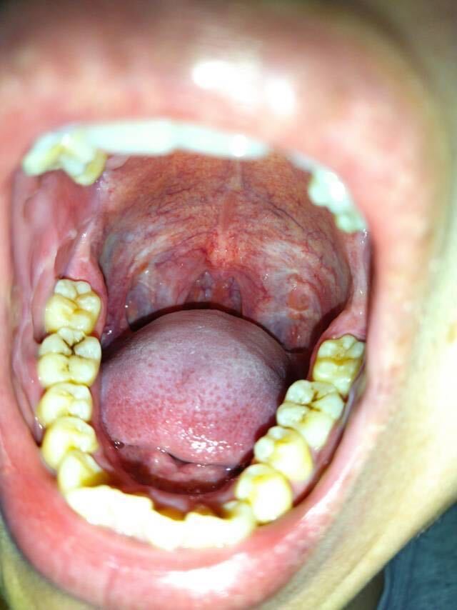 堵塞层面就在软腭该图片可能引起不适继续查看手术后的宽敞术腔该图片