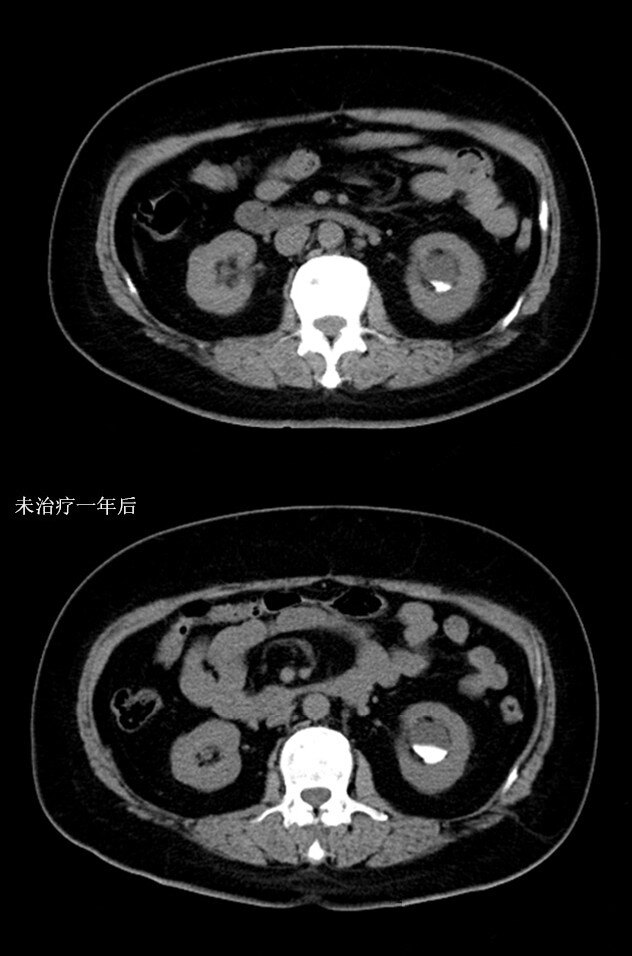 肾囊肿ct图片
