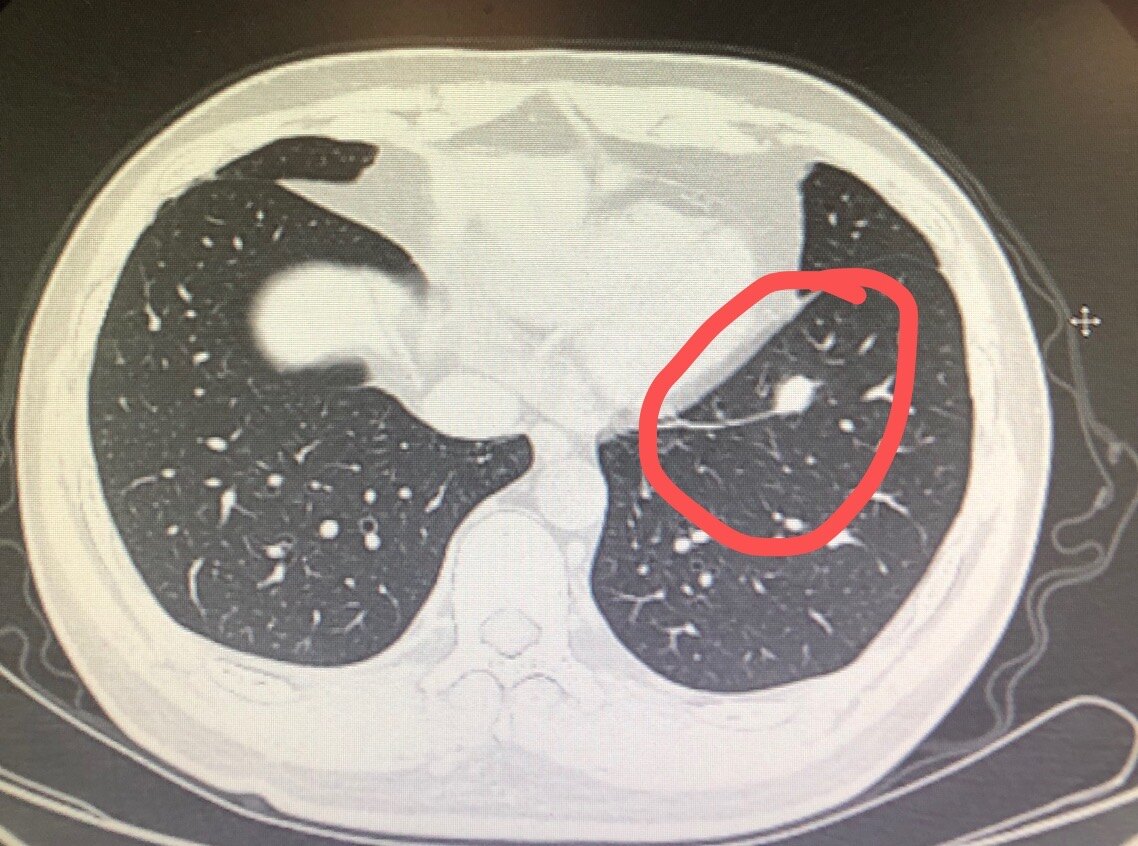 左下肺一实性结节(肉芽肿)