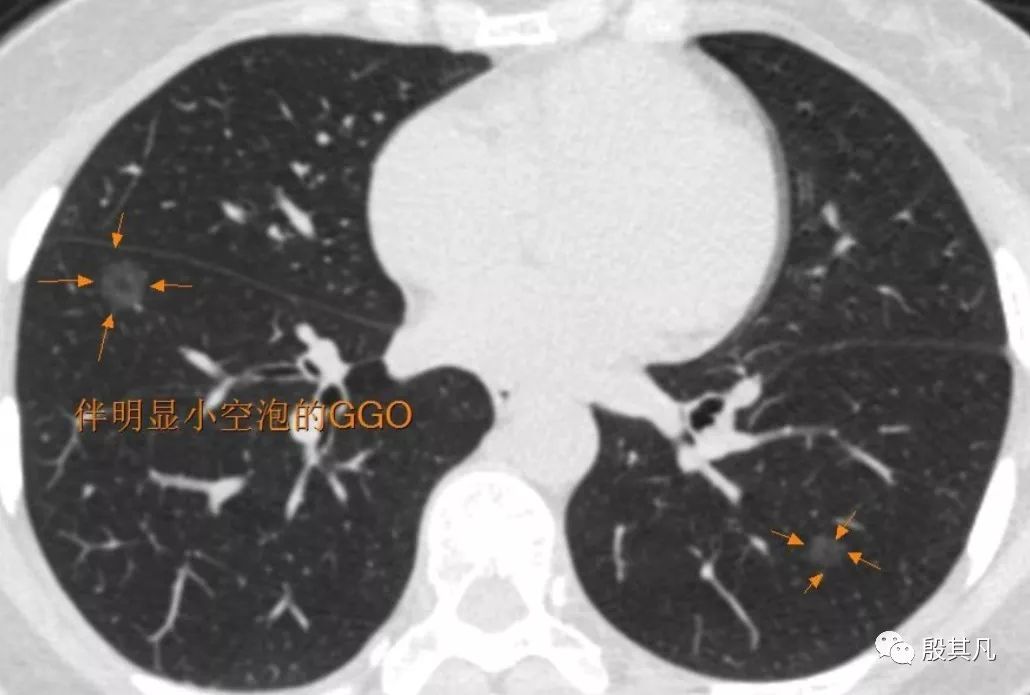 到底什麼樣的肺結節才像早期肺癌 - 好大夫在線