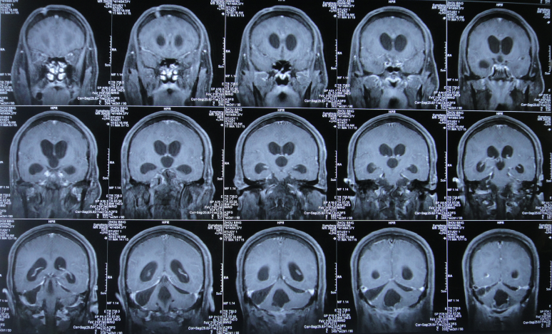 小腦出血術後外院治200天仍意識模糊頭痛,腦積水顱內感染,不能走路,李