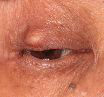 睑缘痣良性 眼睑乳头状瘤良性 眼睑乳头状瘤恶性 基底细胞癌良性 分裂