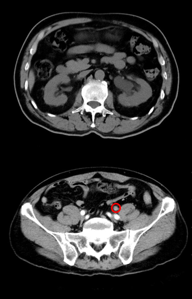 输尿管肿瘤,肾盂肿瘤的检查与治疗 - 好大夫在线