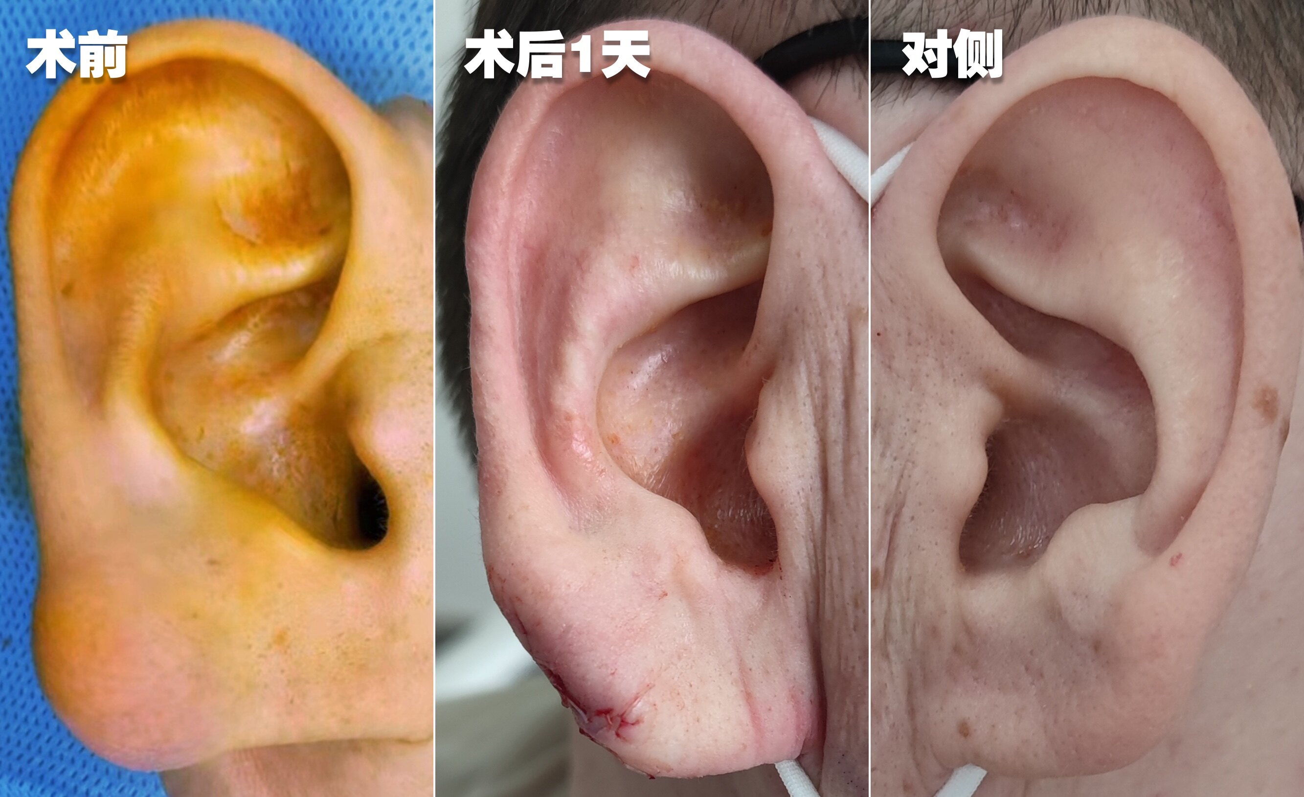 耳前皮脂腺囊肿图片