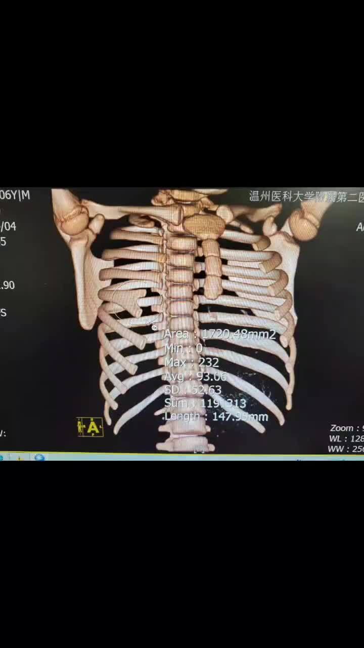 胸壁畸形之肋骨叉状肋