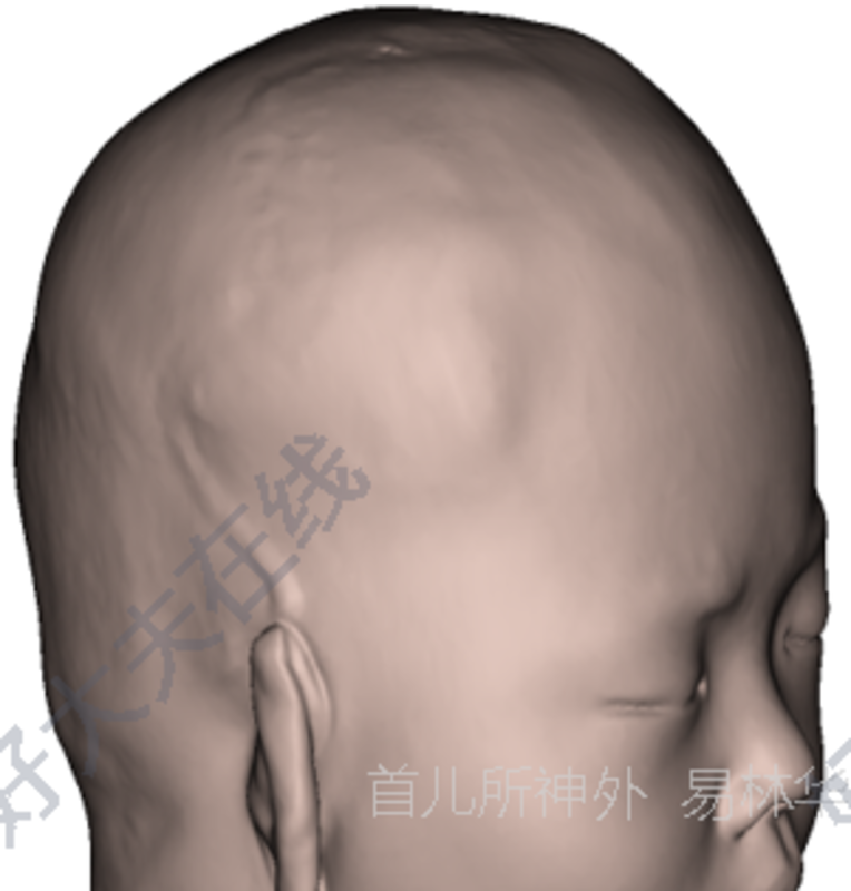 胎儿冠状缝图片图片
