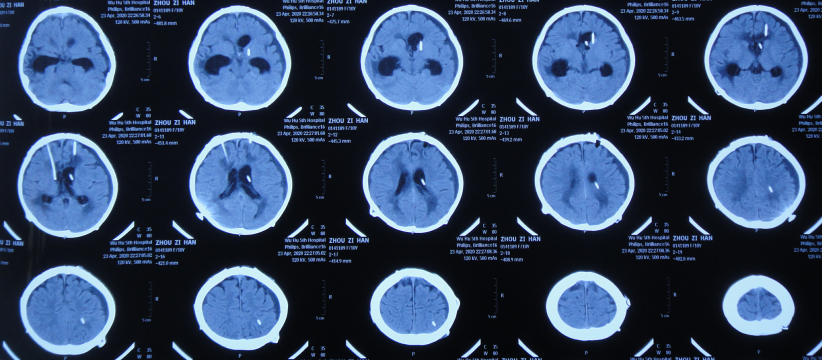 顱內生殖細胞瘤切除術後腦積水仍反覆半年內4家醫院治後顱內感染加重