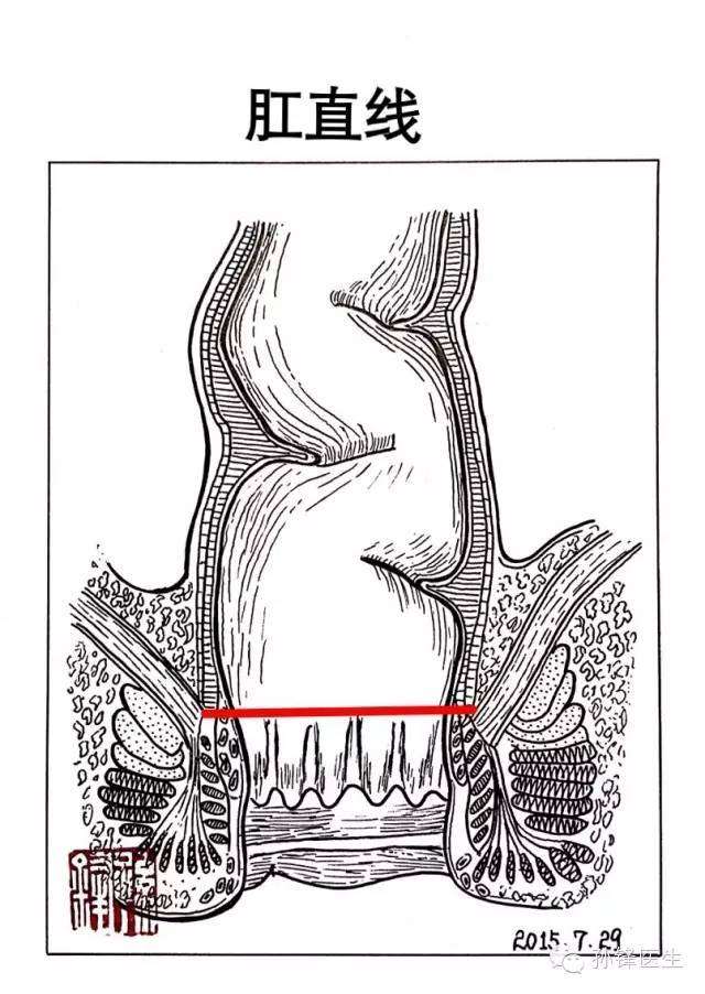 肛隱窩,粘膜下的小凹陷,有炎症時更加深陷.3. 肛隱窩下面就是齒狀 ..