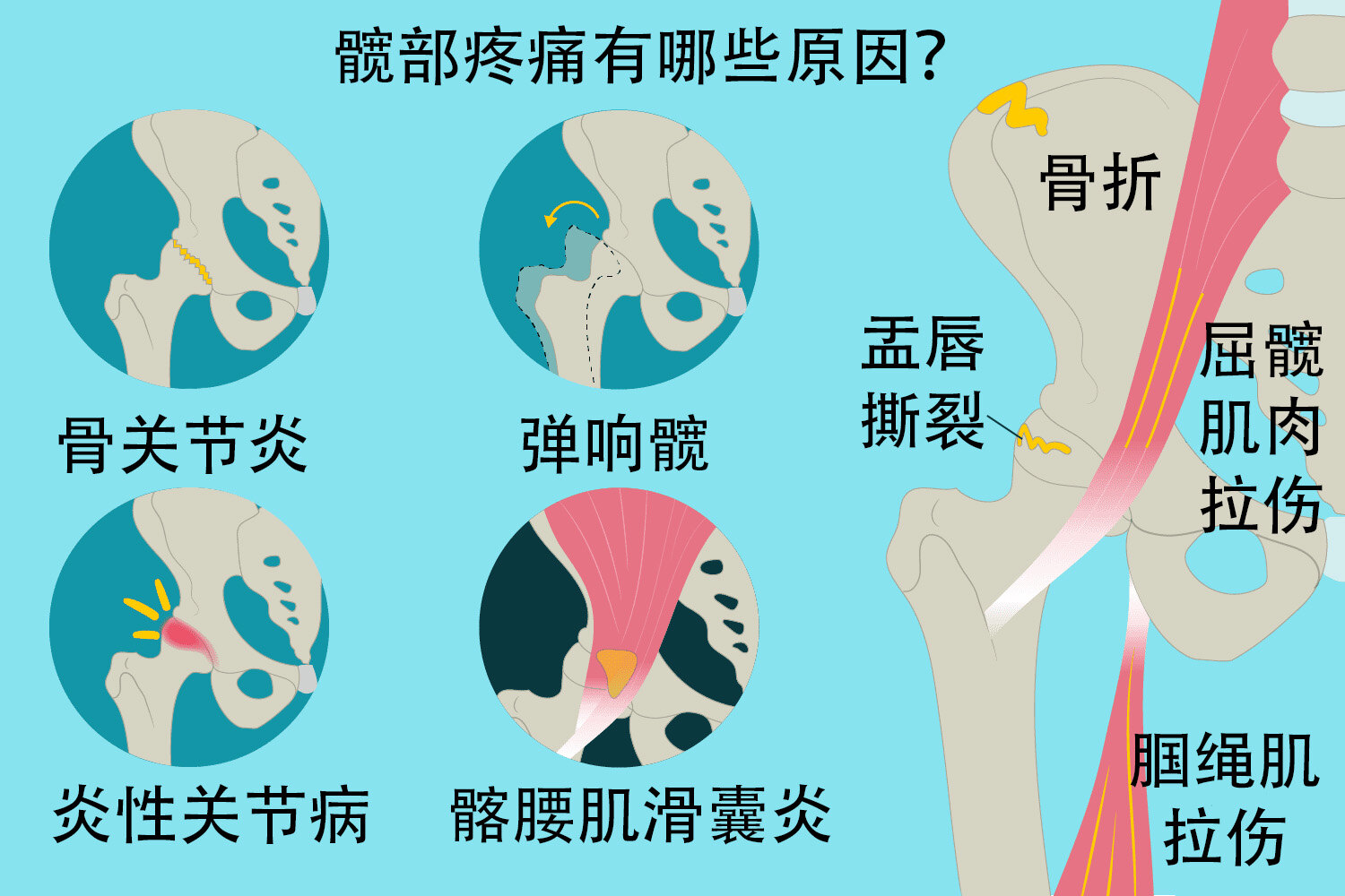 一文搞定令醫生頭痛的髖痛胯痛到底有哪些原因