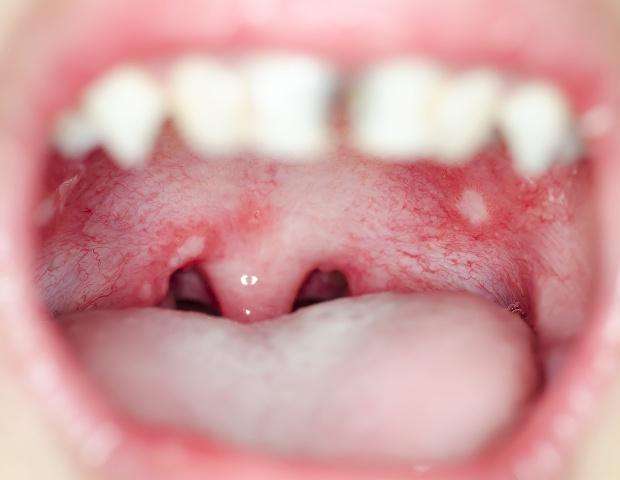 口腔黏膜发炎红肿充血图片
