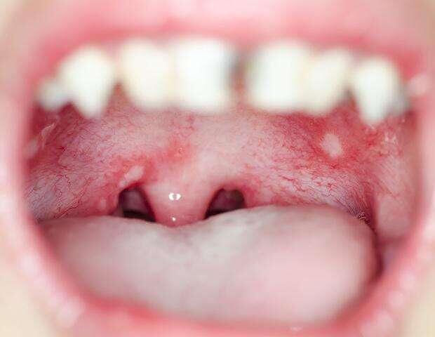 口腔疱疹症状图片