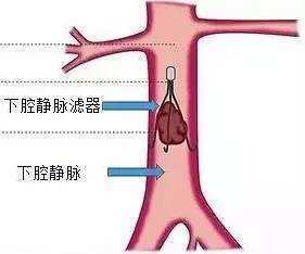 9. 下腔静脉滤器植入.jpg