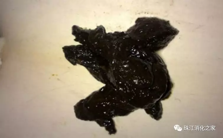 漫谈消化道出血之黑便:为什么我的大便变黑了?_消化道出血_消化道出血介绍 - 好大夫在线