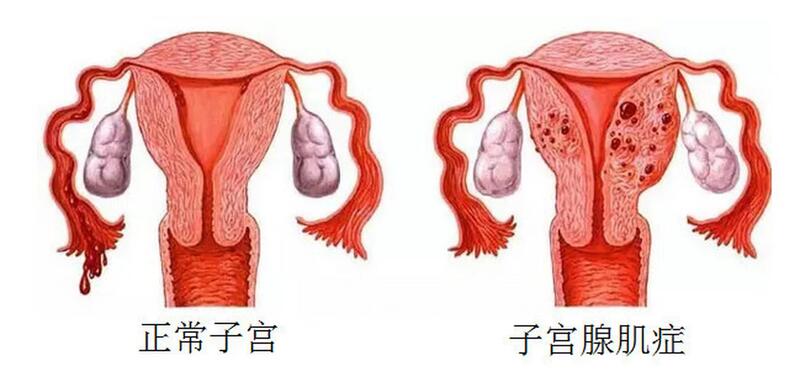 子宫腺肌病.jpg