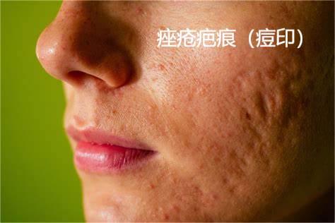 Acne scars 痤疮疤痕.jpg