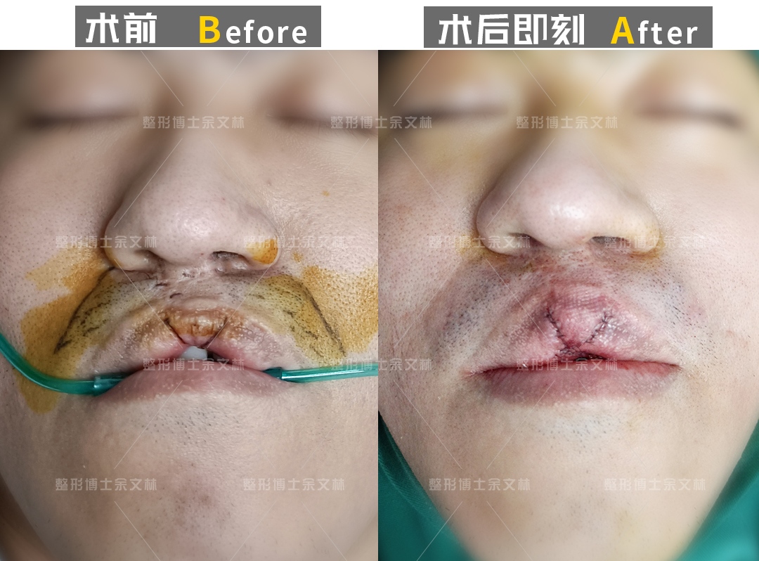 唇裂男子为改善容貌做唇红修复手术 - 好大夫在线