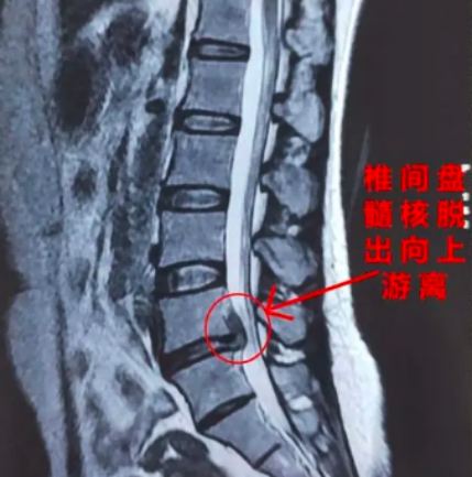 上图是腰椎核磁腰5骶1节段脱出