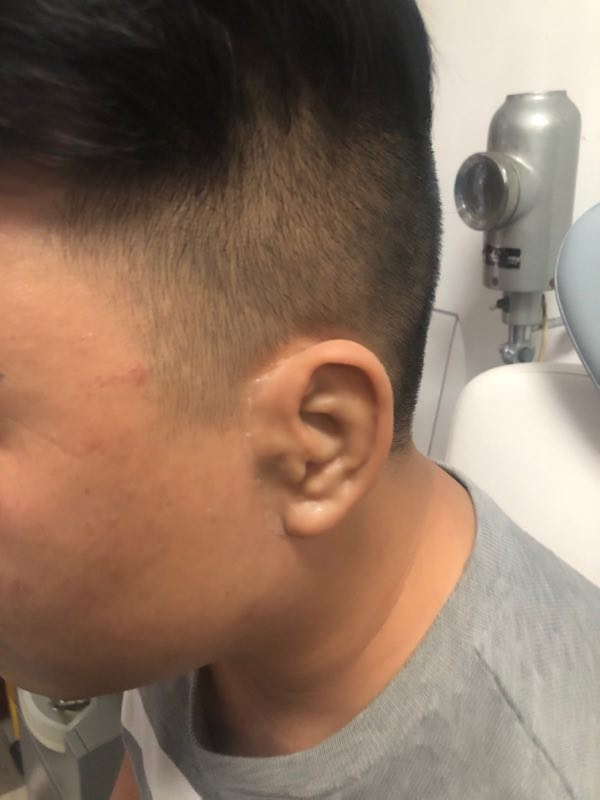 5d硅胶义耳,塑造不一样的人生_小耳畸形_治疗方式_治疗介绍 - 好大夫