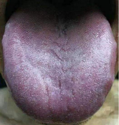 血瘀严重者,嘴唇,眼睑,舌头的颜色会发紫发暗,甚至会出现舌上瘀斑瘀点