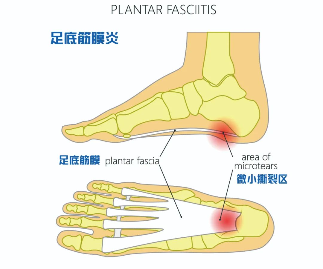 足底筋膜炎解剖图图片