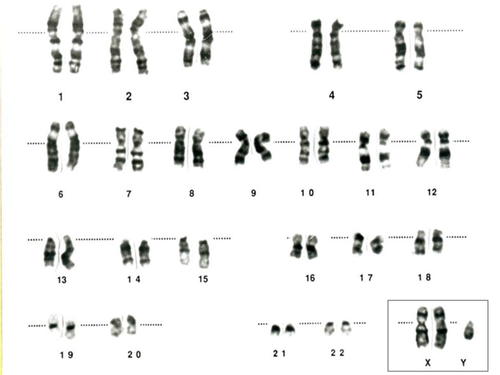 其他非整倍体(48,xxxy,49,xxxxy或48,xxyy,嵌合体(主要是47,xxy 46