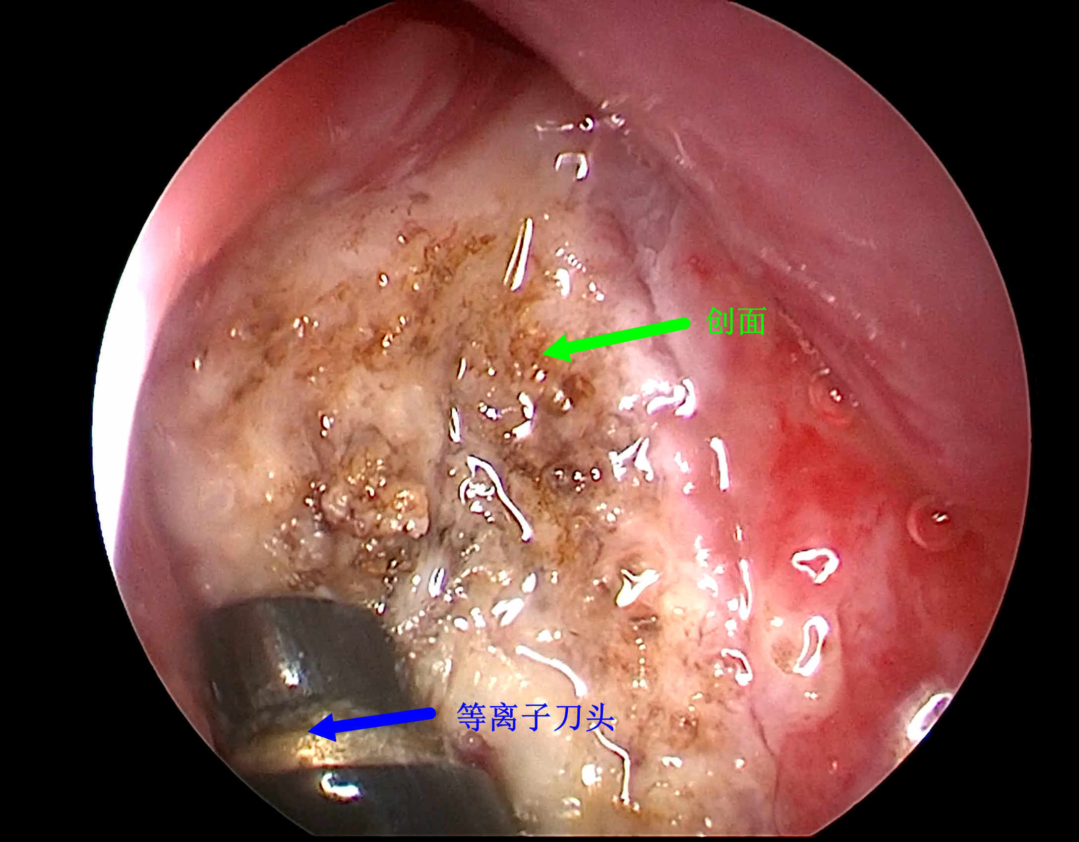 等离子刀头切除腺样体图片