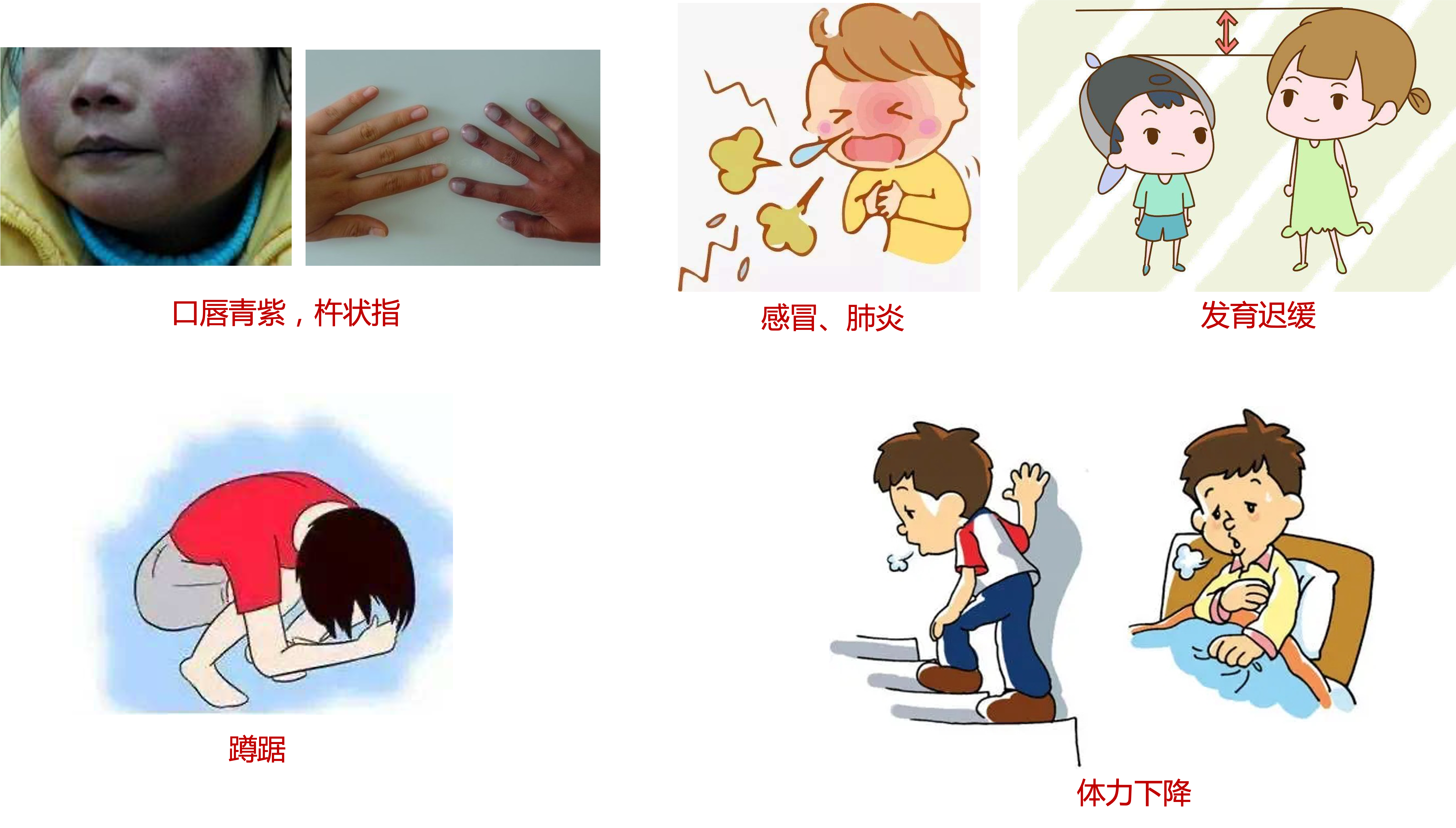 先天性心脏病小知识（三）：哪些表现提示有先心病？_小儿先天性心脏病_小儿先天性心脏病症状表现- 好大夫在线