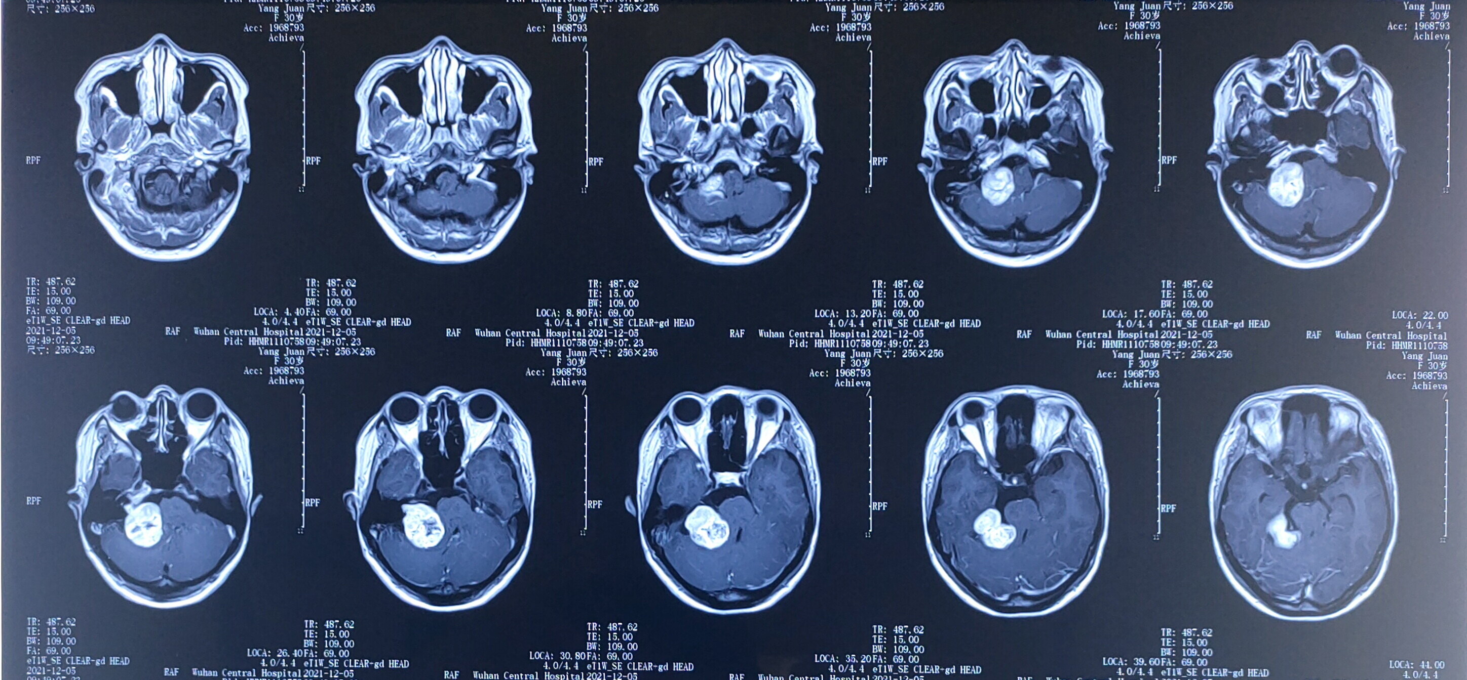 无比开心的笑容,愉快的就医体验---年轻女性大型听神经瘤全切除后面