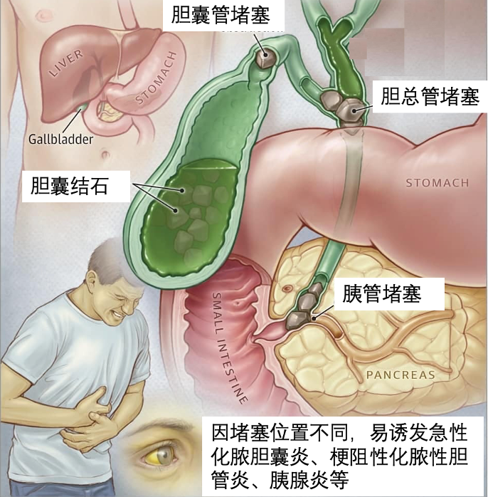 胆结石什么原因引起的 2YYBAGIKLPeANiaxAAqAc0mnNTE600.png?_ms_=2c20