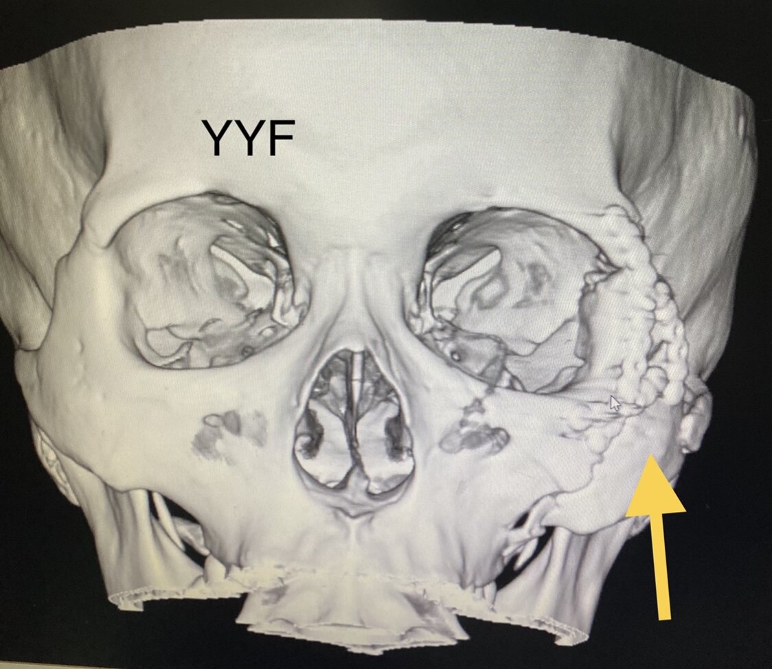 眼眶外侧壁骨折ct图片图片