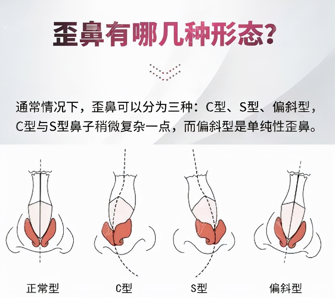 鼻梁歪斜不美观应该如何改善 鼻梁歪斜不美观应该如何改善