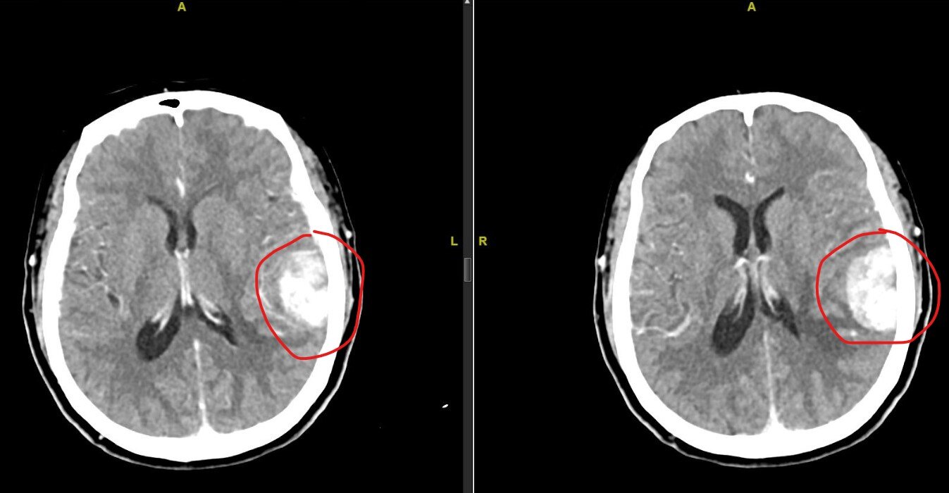 手术切除脑转移瘤1例患者重获新生