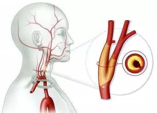 颈动脉小球图片