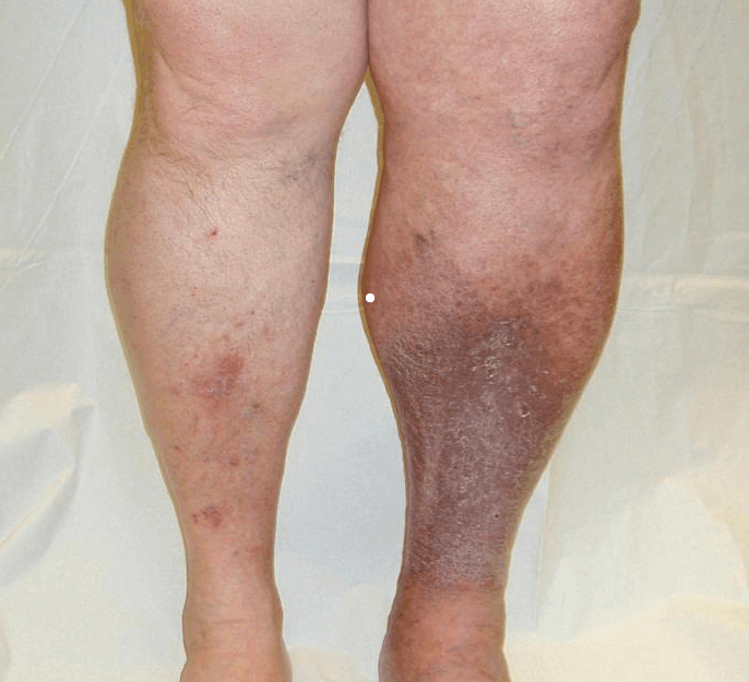 老烂腿是绝症?血管外科医生:你听谁说的?