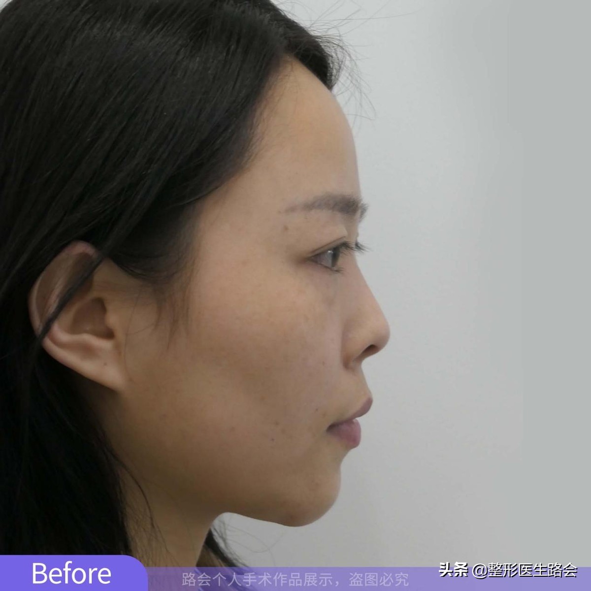 女性耳软骨隆鼻案例反馈 - 知乎