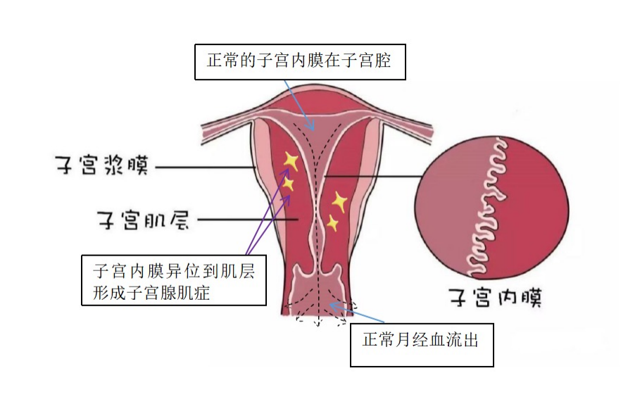 子宫腺肌症1.png