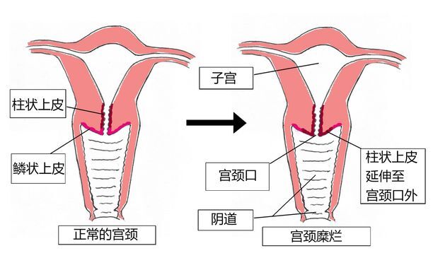 宫颈糜烂≠宫颈癌,也≠生理现象