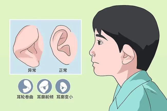 先天耳畸形高发需尽早干预，手术矫正“杯状耳”还孩子正常外观 