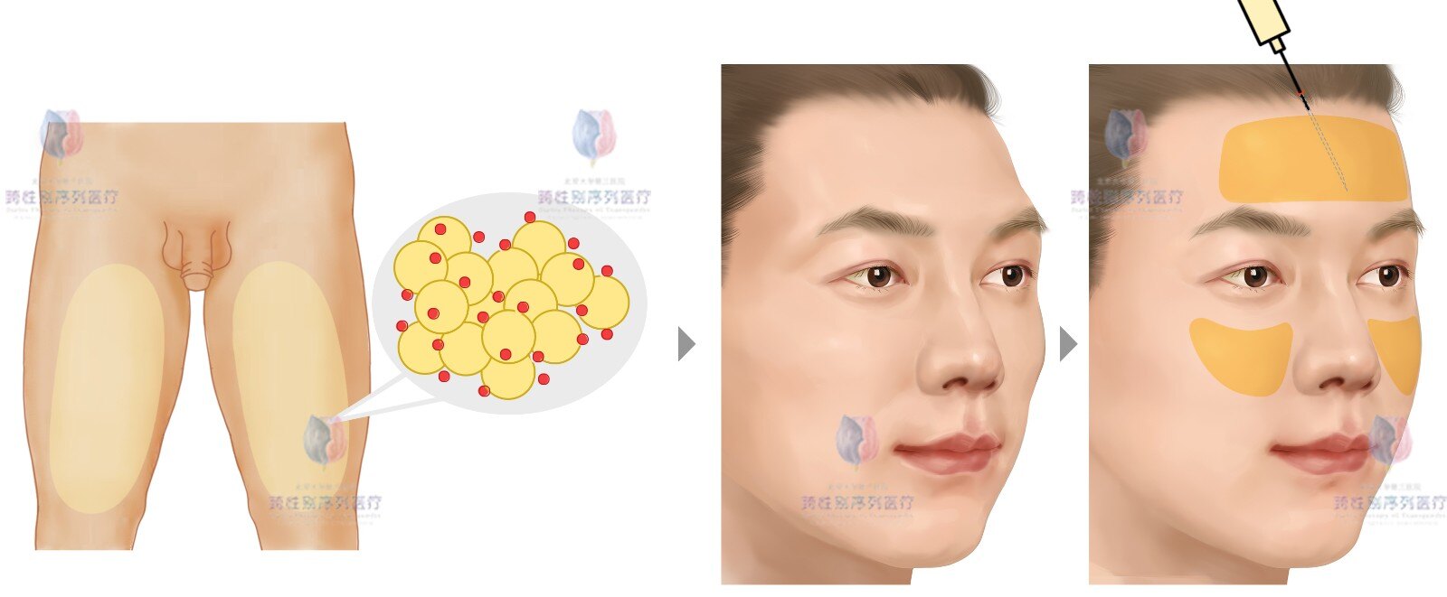 手术治疗 男→女(mtf)_整形_整形相关疾病 - 好大夫在线